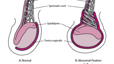 Testis Torsiyonu